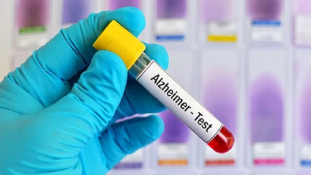 روش‌ های جدید تشخیص آلزایمر