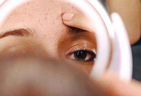 باکتری آکنه و کمک به محافظت از پوست